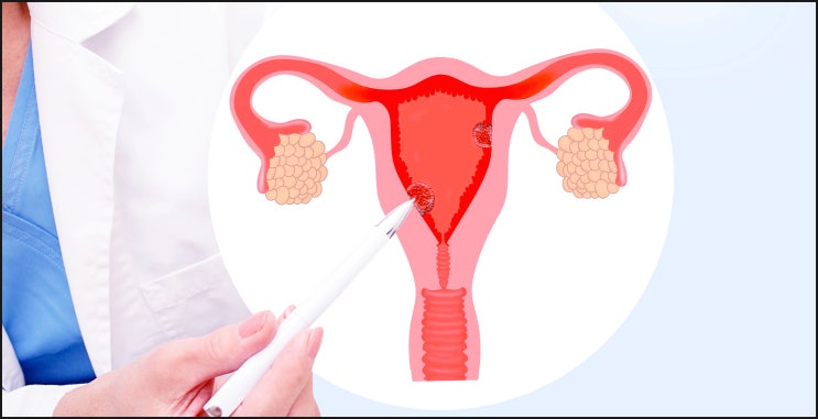 난소낭종/자궁내막증 수술 후기? 확인해도 소용없는 이유