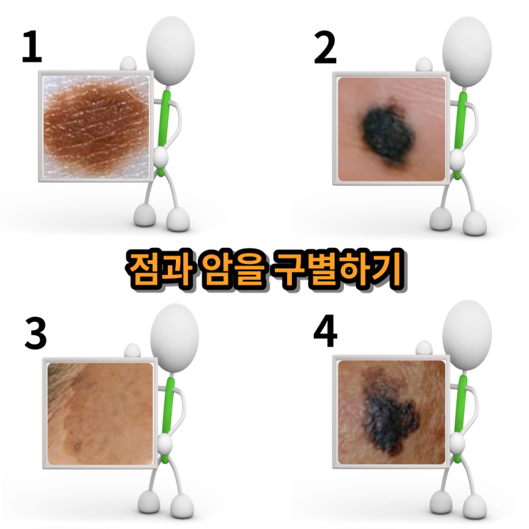  점인 줄 알았더니 말기 암, 발바닥 흑색종
