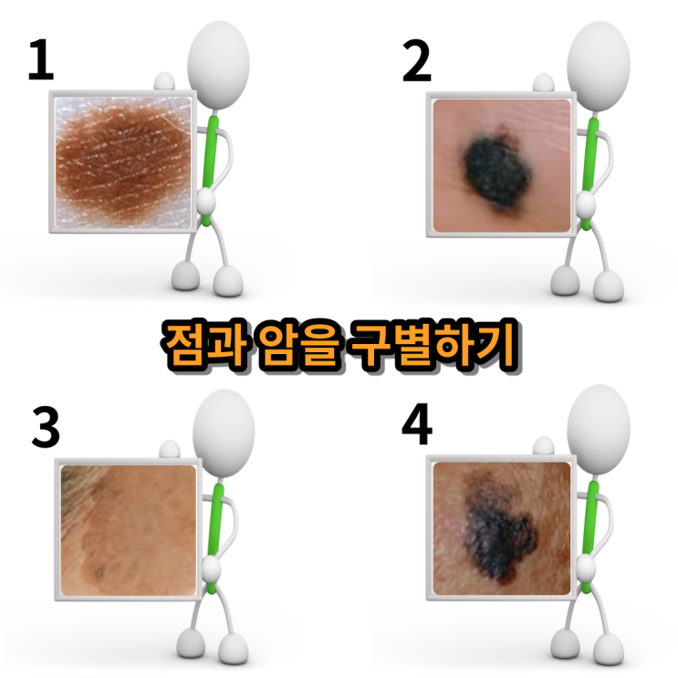 점인 줄 알았더니 말기 암, 발바닥 흑색종