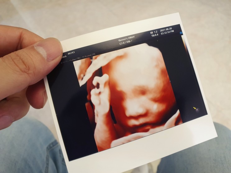 [튼별이의 이야기] 천안 퀸스산부인과 임신24주 임신성당뇨 검사 및 입체초음파