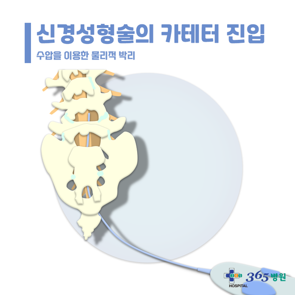 [창원마산 척추관절 디스크 365병원] 신경성형술