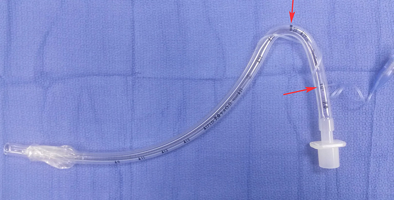 [마취] Nasotracheal (Nasal) intubation 경비 삽관_ 구강, 악안면외과, 치과, 양악 수술 : 네이버 블로그