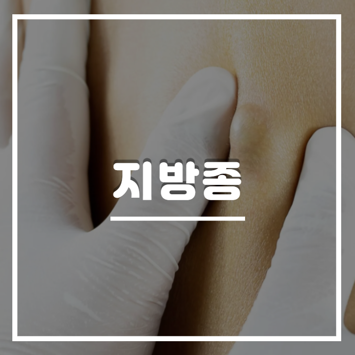 지방종의 원인 제거(목밑 얼굴 등) 2