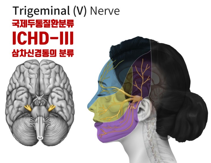 국제두통질환분류(ICHD-III)에 근거한 삼차신경통의 분류