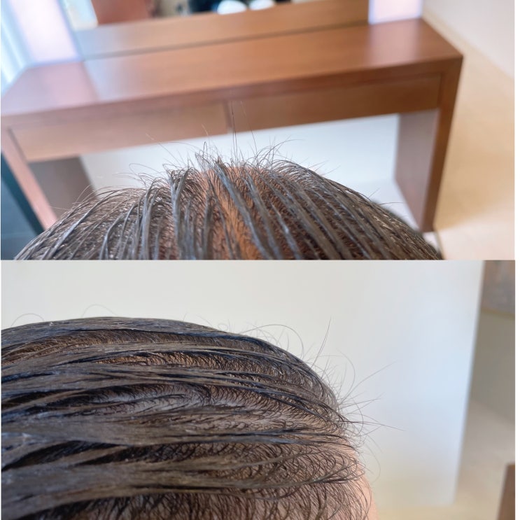  울산 두피케어 6회관리로 진짜 머리나는 헤어바이임혜란 결과로말하는곳