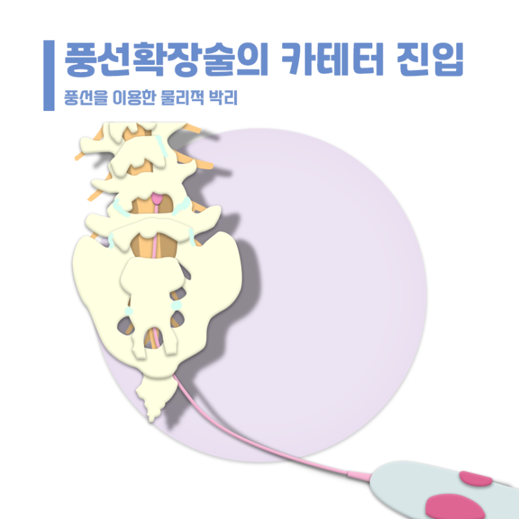  [창원마산 척추관절 디스크 365병원] 경피적 경막외 풍선확장술
