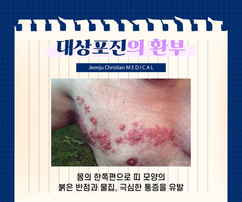 전주대상포진 치료! 초기증상이 느껴진다면!