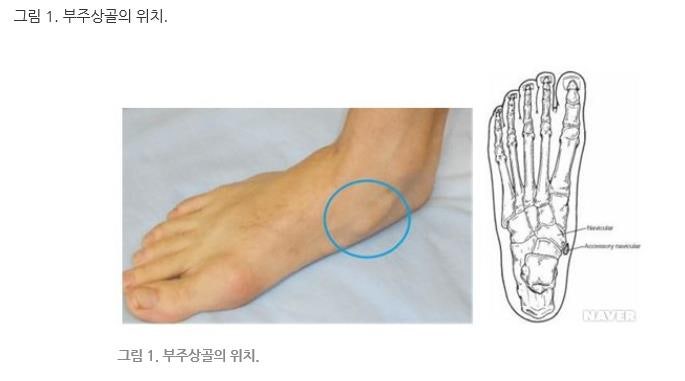 부주상골 증후군의 증상과 치료, 평발, 수술. 군대에 갑니까?