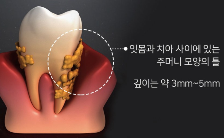  치주포켓을 없애고 싶다면? 아쿠아픽 코드리스