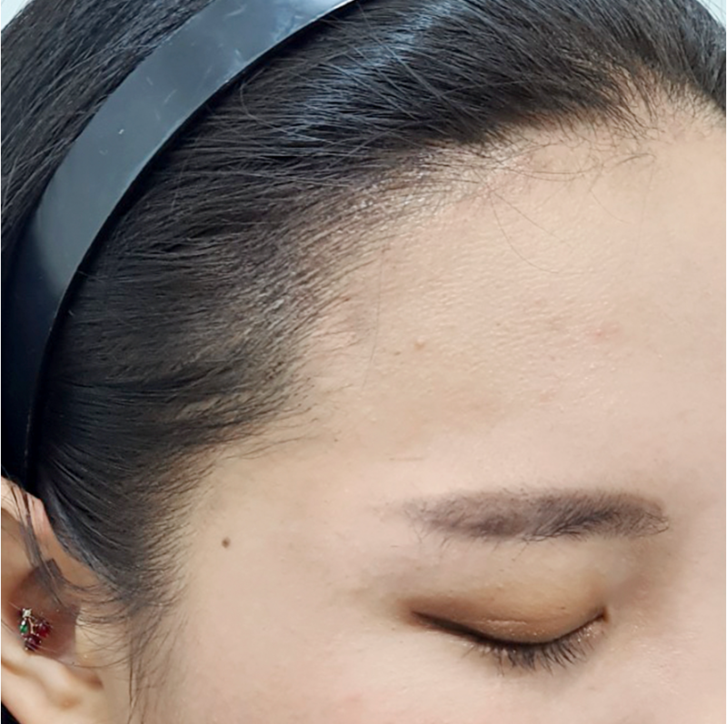 M자 태평양 이마, 헤어라인 타투로 작은 얼굴 완성!