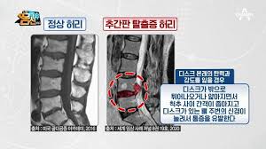  허리디스크HNP 원인증상 통증특징 진단진찰치료방법 추간판절제수술 다리통증요통 추간판돌출증 간호진단과정