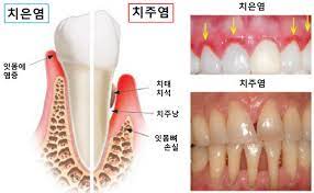  치주염 원인증상 치태치석특징 예방치료방법 잇몸염증통증 초기중기말기단계 풍치경과예후 간호중재
