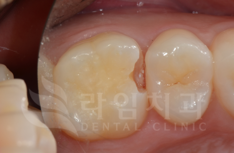 치간우식증의 합리적인 치료