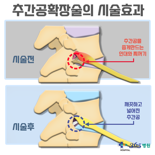  [창원마산 척추관절 디스크 365병원] 경피적 추간공 확장술