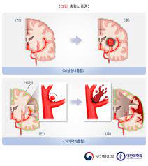  간호학공부 두개내압상승 치료약물종류 기도유지자세 과호흡유도혼수요법 감압술VPSHUNT 뇌실복강단락술 간호중재