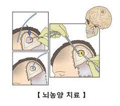  뇌농양 원인특징 대표증상 항생제치료 흡인술절제술 세균감염농양염증 두통고름 부비동염중이염 합병증경과예후