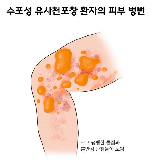 피부에 물집이 자주 생긴다면?...수포성 유사천포창