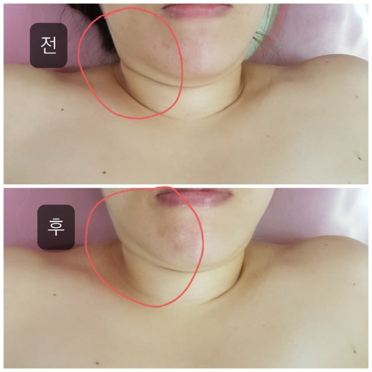  구미 신부 피부관리 물방울리프팅 1회관리 만족후기 봉곡동 마실뷰티