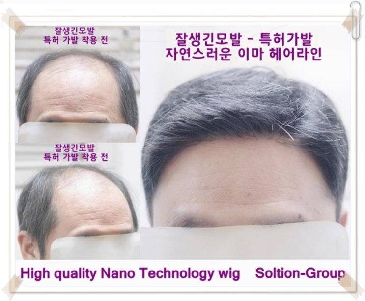  영등포가발 합정 홍대 남자 헤어증모술 남성부분맞춤 붙임머리