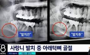  턱뼈골절 치아빠짐탈구 원인증상 손상부위특징 빠진이빨대처방법 병원치료 합병증경과예후 간호중재과정