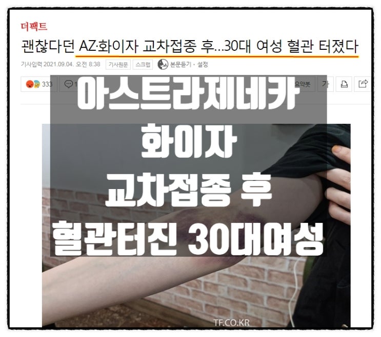 아스트라제네카, 화이자 교차접종 후 팔뚝혈관 터져버린 30대여성 아스트라제네카, 화이자 교차접종 후 팔뚝혈관 터져버린 30대여성