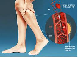  혈전증 코로나백신부작용 항응고제 혈전용해제약물치료 경과예후 폐색전증 심부정맥혈전증사망률 와파린헤파린 간호중재진단