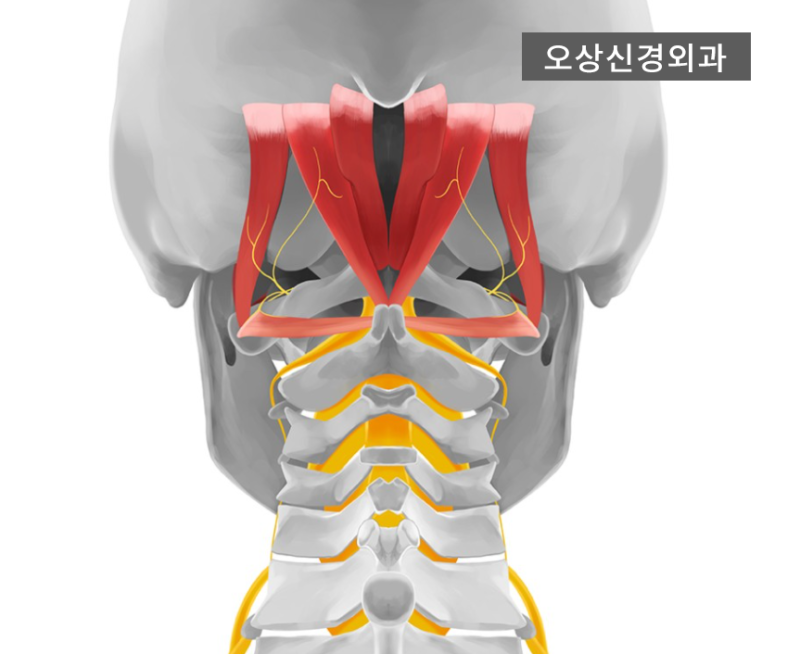 왼쪽 뒤통수 통증, 어떤 원인으로 나타날까? : 네이버 블로그 왼쪽 뒤통수 통증, 어떤 원인으로 나타날까? : 네이버 블로그