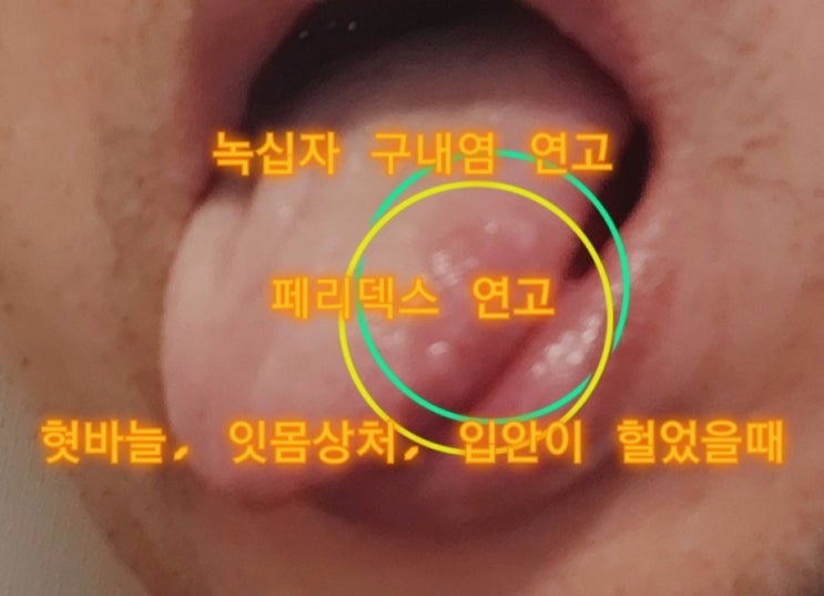  녹십자 구내염 연고 | 페리덱스 연고 | 혓바늘, 잇몸상처, 입안이 헐었을때