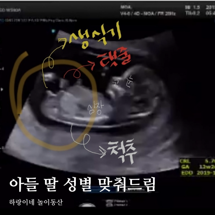 아기 초음파사진 각도법 삼각점 태아 성별 확인 해드림