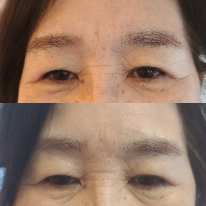 플라즈마 블라스트 콧날 옆주름 1-2일차(안쪽둘레) 3