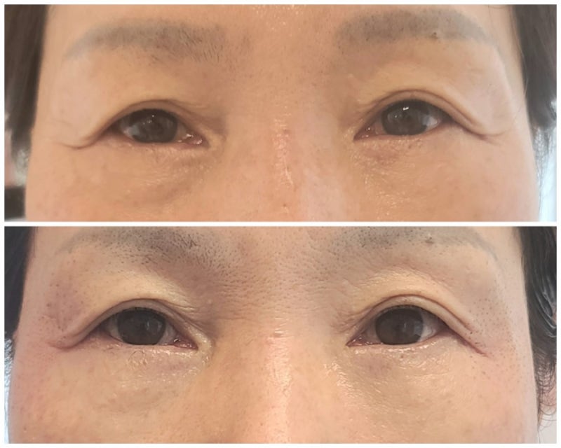 플라즈마 블라스트 콧날 옆주름 1-2일차(안쪽둘레) 2