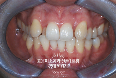  [성인교정] 덧니가 심해서 사진이 안 이뻐요