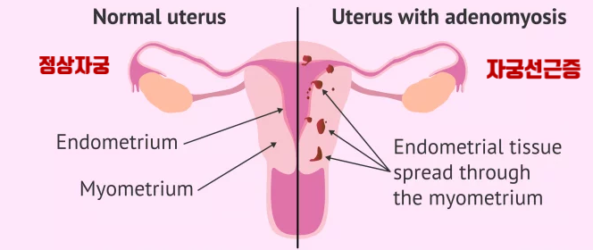자궁선근증(adenomyosis), 자궁출혈, 붕루, 빈혈 수치점검