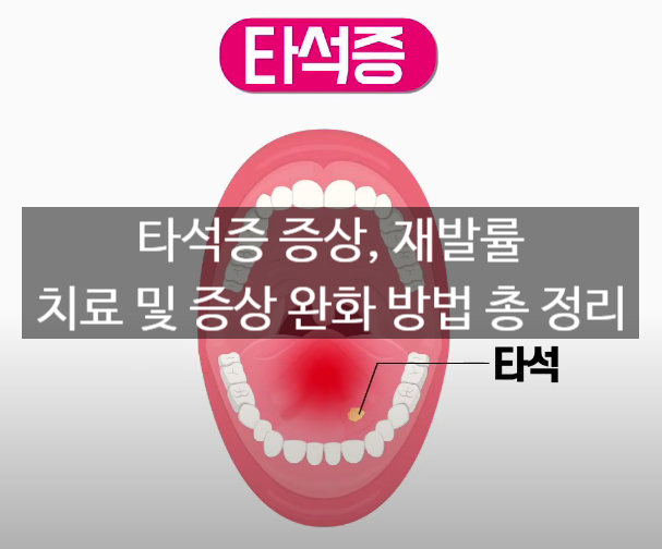 타석증 증상, 재발률, 치료 및 증상 완화 방법 총 정리