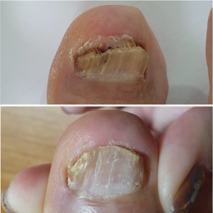  네일샵 케어없이 안티펑세럼만으로 무좀발톱관리 하고 계신 분의 중간 결과 안산무좀발톱 홈케어