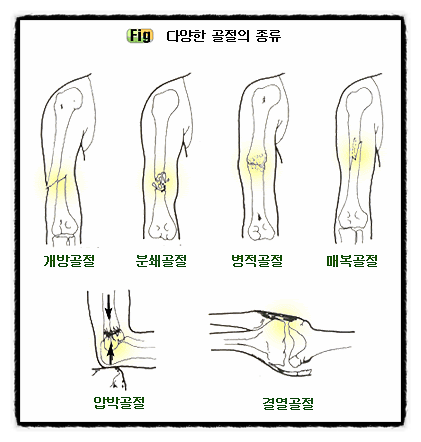  부러진 뼈는 왜 붙나, 재생 능력, 골절 혈관 골아 세포