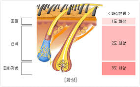  화상 원인증상 1도~4도분류 병원치료방법 화상응급처치 금지주의사항 흉터손상 수포물집 간호중재
