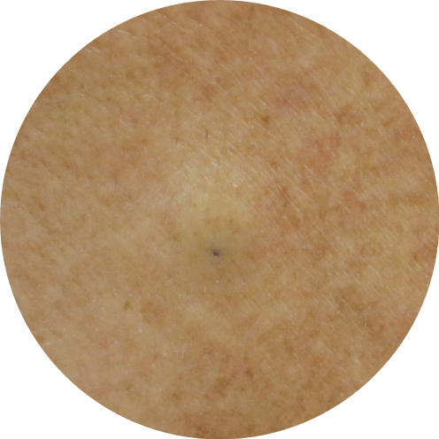 표피낭종 (Epidermal cyst), 완벽하게 제거가 어려운 이유? : 네이버 블로그