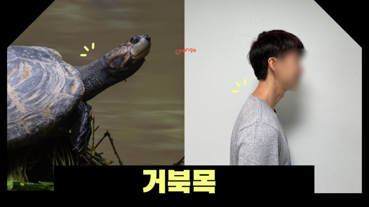  강동구 거북목 자가진단과 운동법  - 강동모커리한방병원