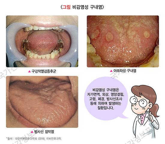  항암치료 부작용 - 구내염 관리