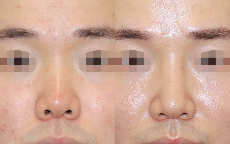 남자코수술후기_남자짧은코수술후 이미지 변신 확실하게 : 네이버 블로그 남자코수술후기_남자짧은코수술후 이미지 변신 확실하게 : 네이버 블로그