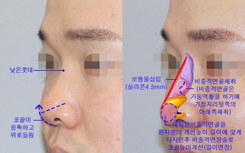 남자코수술후기_남자짧은코수술후 이미지 변신 확실하게 : 네이버 블로그 남자코수술후기_남자짧은코수술후 이미지 변신 확실하게 : 네이버 블로그