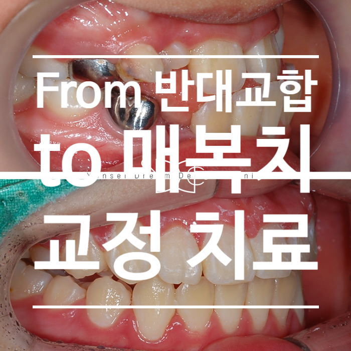 어린이 반대교합(턱 교정)부터 매복치까지 교정 치료하기, 미사역 교정, 꿈꾸는아치치과 & 교정과 어린이 반대교합(턱 교정)부터 매복치까지 교정 치료하기, 미사역 교정, 꿈꾸는아치치과 & 교정과