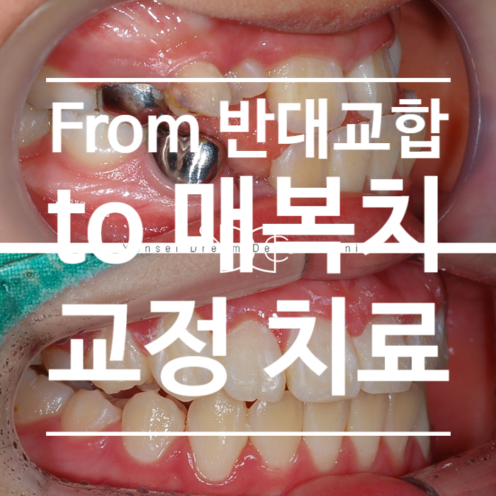 어린이 반대교합(턱 교정)부터 매복치까지 교정 치료하기, 미사역 교정, 꿈꾸는아치치과 & 교정과