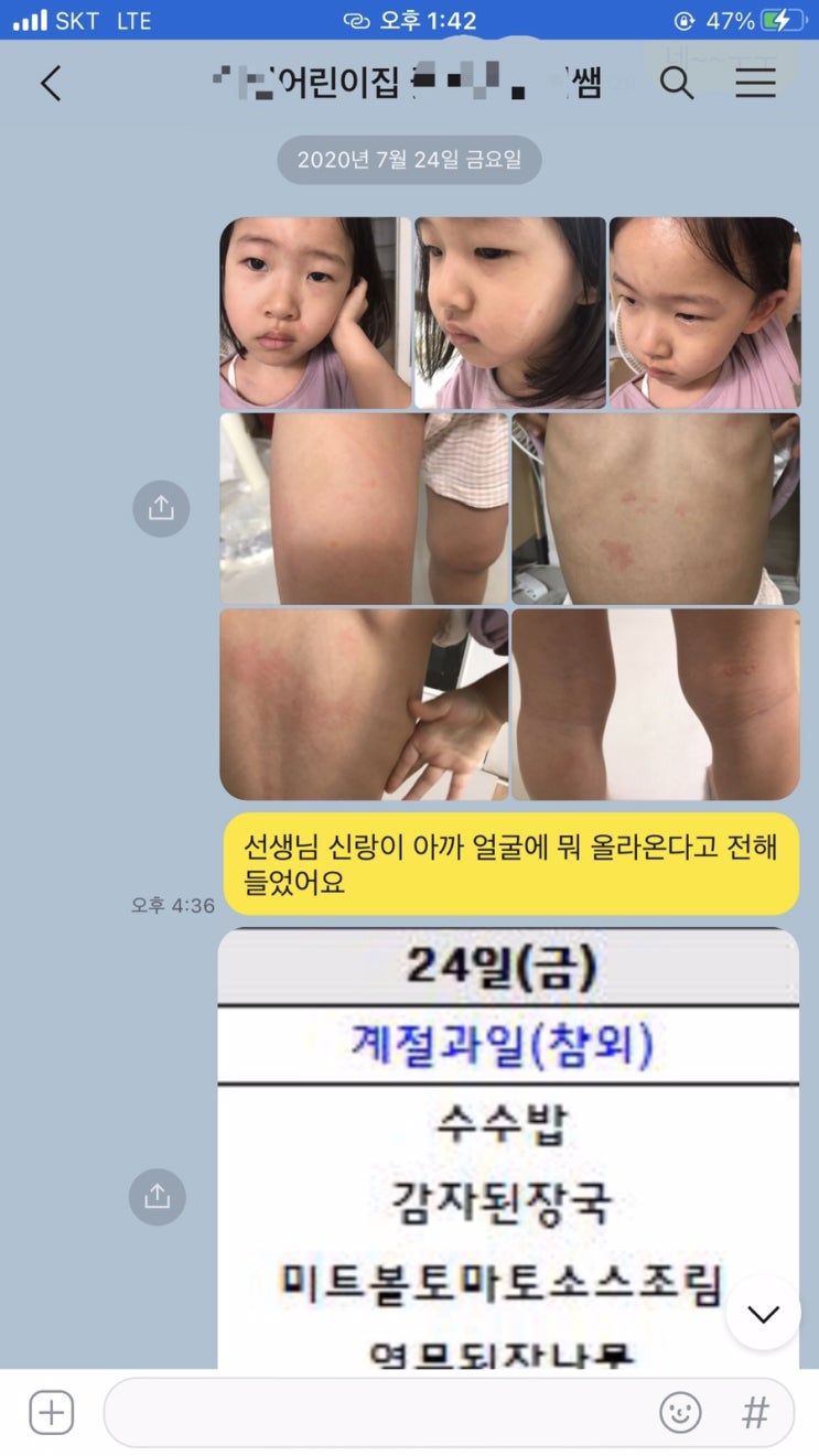  5세 유아 알레르기/ 유아 두드레기