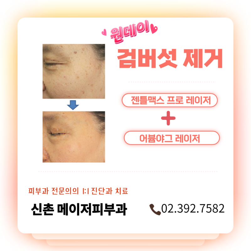 검버섯 제거_ 효과적인 피부 관리 방법