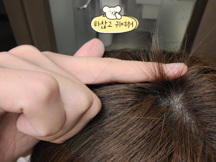  스트레스 받지마! 원형탈모 생긴다!