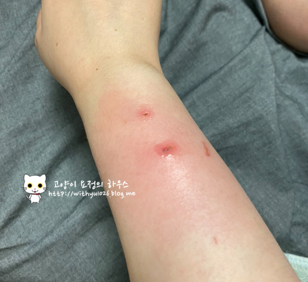  고양이에게 깊게 물렸을때 늦게 병원에 가면 생기는 일(feat. 봉와직염)