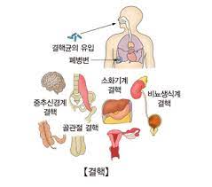  결핵 전염병원인 증상특징 병원진단검사 항결핵제4가지치료 주의사항 결핵균전파감염예방 간호중재진단과정