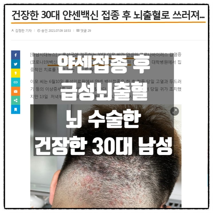 191cm 에 120kg 이던 건장한 30대 남성 얀센접종후 비외상성 급성 뇌출혈로 뇌수술 후 왼팔, 왼다리 마비.